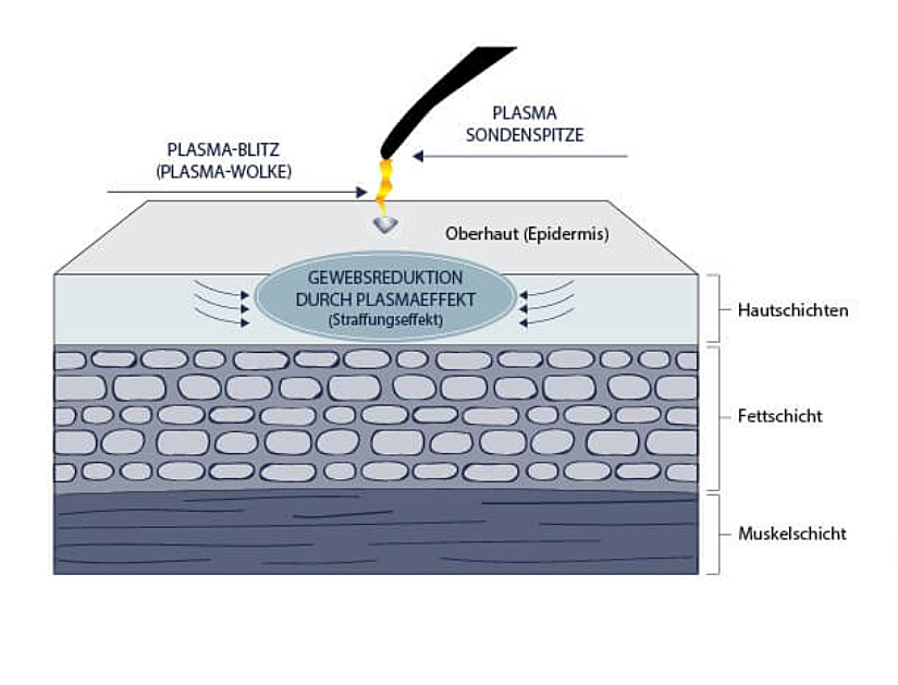 Plasmatechnologie für eine sofort sichtbare Straffung ohne OP